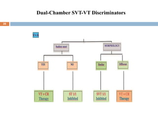 Dual-Chamber SVT-VT Discriminators
26
 