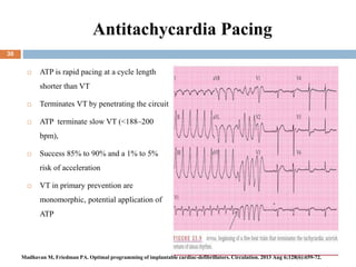 Antitachycardia Pacing
 ATP is rapid pacing at a cycle length
shorter than VT
 Terminates VT by penetrating the circuit
 ATP terminate slow VT (<188–200
bpm),
 Success 85% to 90% and a 1% to 5%
risk of acceleration
 VT in primary prevention are
monomorphic, potential application of
ATP
30
Madhavan M, Friedman PA. Optimal programming of implantable cardiac-defibrillators. Circulation. 2013 Aug 6;128(6):659-72.
 
