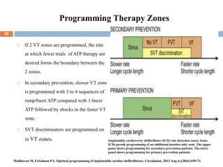 Programming Therapy Zones
 If 2 VT zones are programmed, the rate
at which fewer trials of ATP therapy are
desired forms the boundary between the
2 zones.
 In secondary prevention, slower VT zone
is programmed with 3 to 4 sequences of
ramp/burst ATP compared with 1-burst
ATP followed by shocks in the faster VT
zone.
 SVT discriminators are programmed on
in VT zones. Implantable cardioverter defibrillator (ICD) rate detection zones. Some
ICDs permit programming of an additional monitor-only zone. The upper
panel shows programming for secondary prevention patients. The lower
panel shows programming for primary prevention patients.
36
Madhavan M, Friedman PA. Optimal programming of implantable cardiac-defibrillators. Circulation. 2013 Aug 6;128(6):659-72.
 