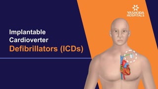 Implantable
Cardioverter
Defibrillators (ICDs)
 