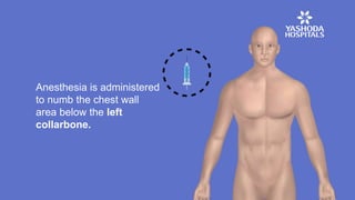 Anesthesia is administered
to numb the chest wall
area below the left
collarbone.
 