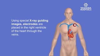 Using special X-ray guiding
images, electrodes are
placed in the right ventricle
of the heart through the
veins.
 