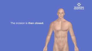 The incision is then closed.
 
