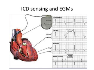 ICD sensing and EGMs
 