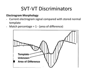 Electrogram Morphology
• Current electrogram signal compared with stored normal
template
• Match percentage = 1 - (area of difference)
SVT-VT Discriminators
 
