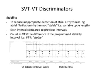 Stability
• To reduce inappropriate detection of atrial arrhythmias eg
atrial fibrillation (rhythm not “stable” i.e. variable cycle length)
• Each interval compared to previous intervals
• Count as VT if the difference  the programmed stability
interval i.e. VT is “stable”
VT detection interval: 500ms Stability 30ms
SVT-VT Discriminators
 