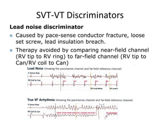 Lead noise discriminator
 Caused by pace-sense conductor fracture, loose
set screw, lead insulation breach.
 Therapy avoided by comparing near-field channel
(RV tip to RV ring) to far-field channel (RV tip to
Can/RV coil to Can)
SVT-VT Discriminators
 
