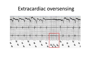 Extracardiac oversensing
 