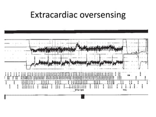 Extracardiac oversensing
 