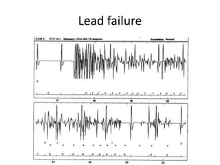 Lead failure
 
