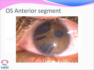 OS Anterior segment
 