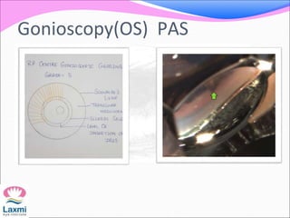 Gonioscopy(OS) PAS
 