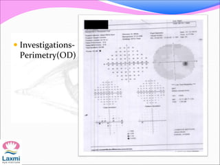  Investigations-
Perimetry(OD)
 