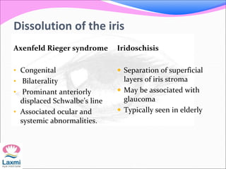Dissolution of the iris
Axenfeld Rieger syndrome
• Congenital
• Bilaterality
• Prominant anteriorly
displaced Schwalbe’s line
• Associated ocular and
systemic abnormalities.
Iridoschisis
 Separation of superficial
layers of iris stroma
 May be associated with
glaucoma
 Typically seen in elderly
 