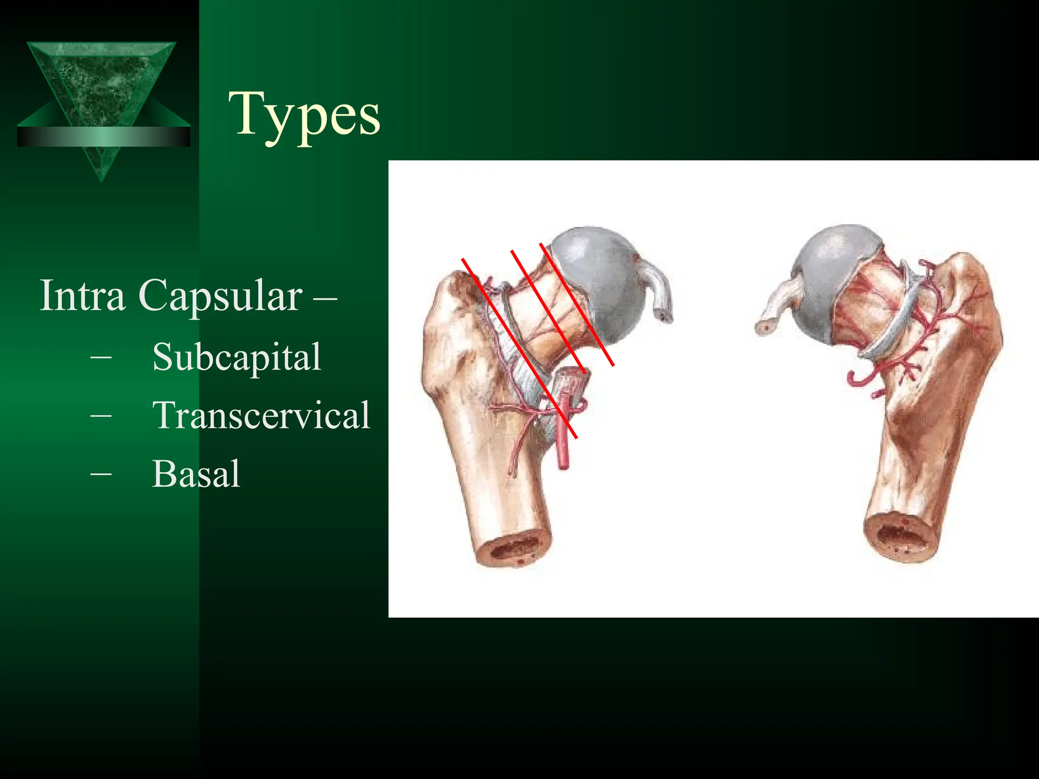 Types
Intra Capsular –
– Subcapital
– Transcervical
– Basal
 