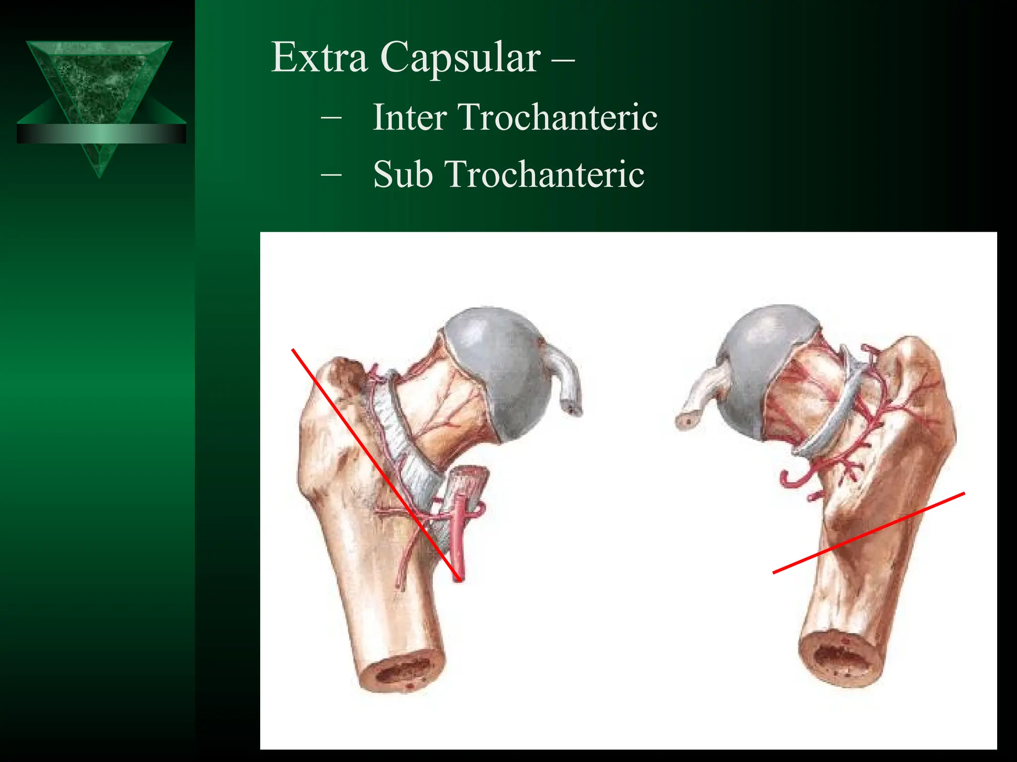 Extra Capsular –
– Inter Trochanteric
– Sub Trochanteric
 