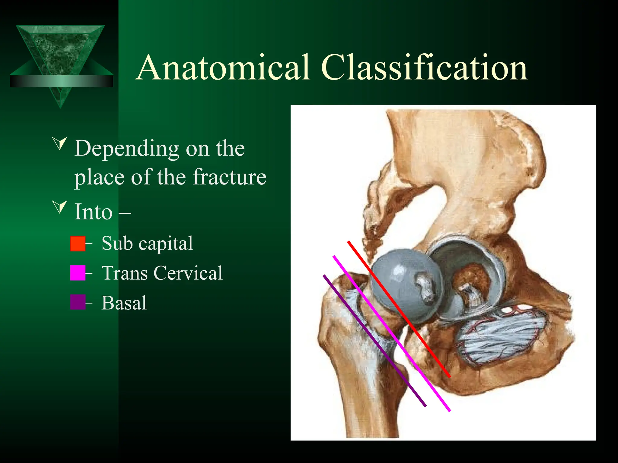 Anatomical Classification
 Depending on the
place of the fracture
 Into –
– Sub capital
– Trans Cervical
– Basal
 