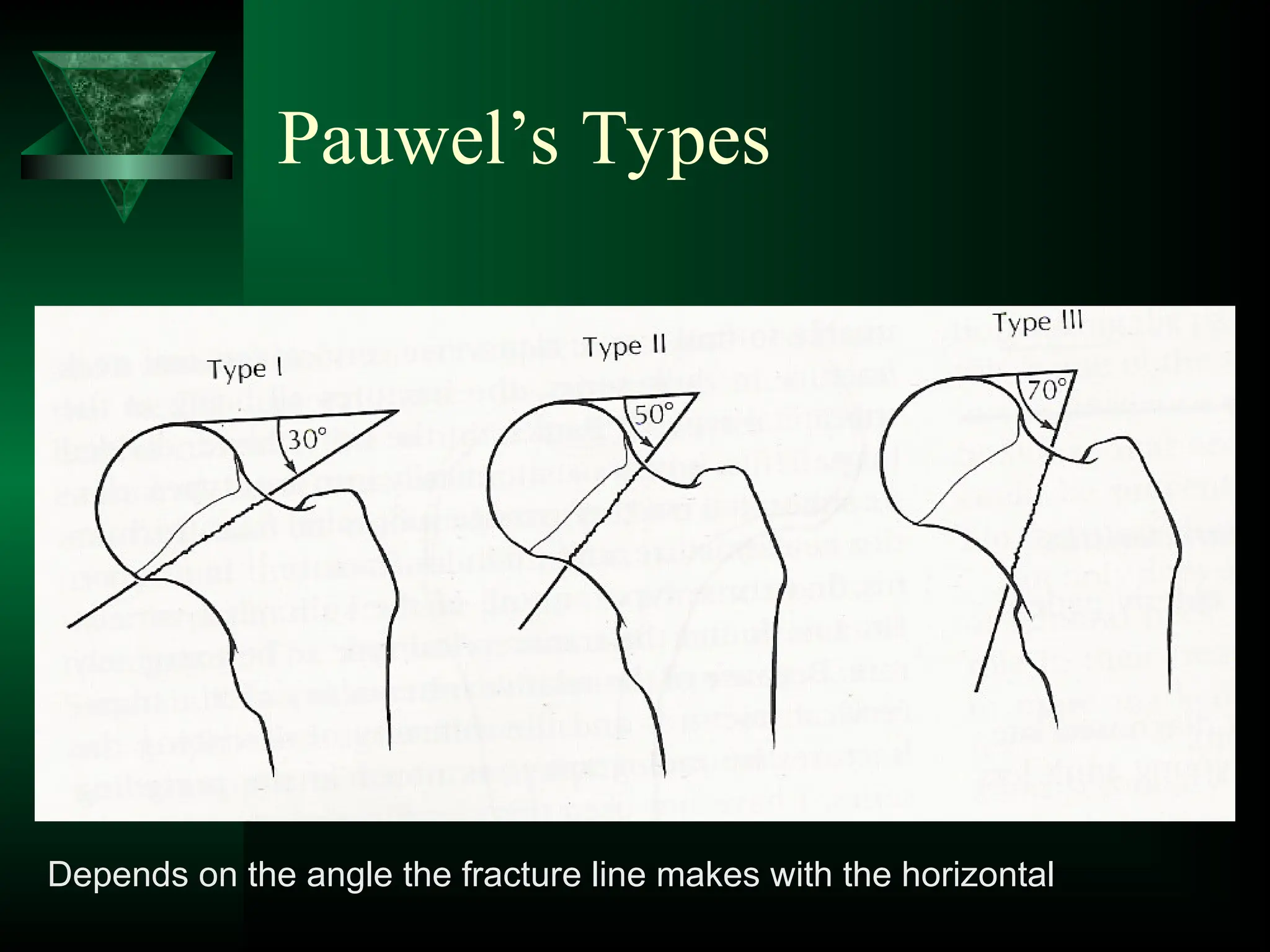 Pauwel’s Types
Depends on the angle the fracture line makes with the horizontal
 