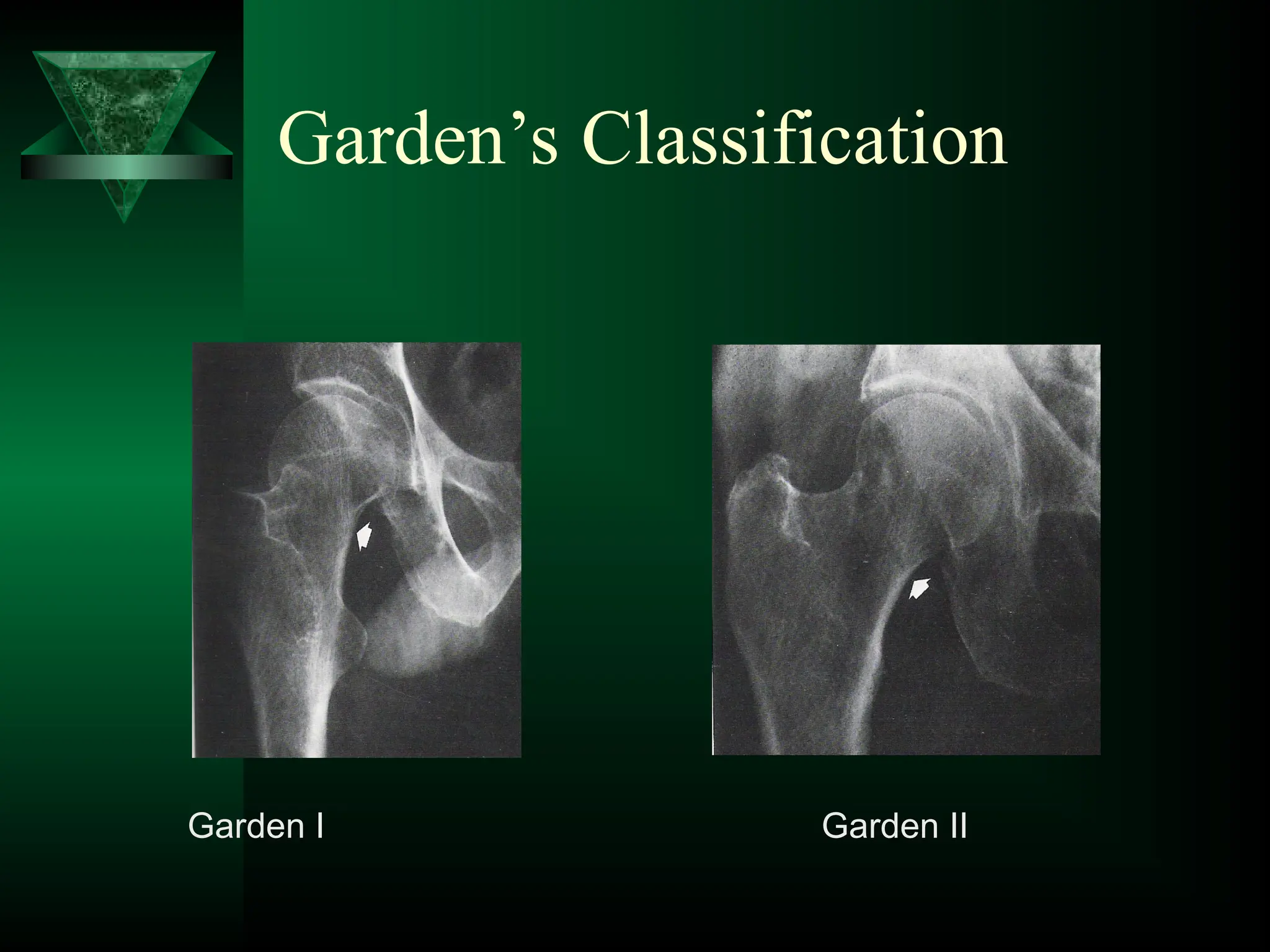 Garden’s Classification
Garden I Garden II
 