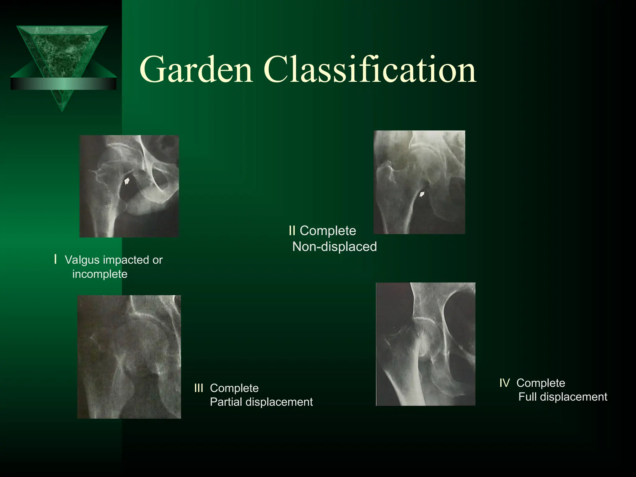 Garden Classification
I Valgus impacted or
incomplete
II Complete
Non-displaced
III Complete
Partial displacement
IV Complete
Full displacement
 