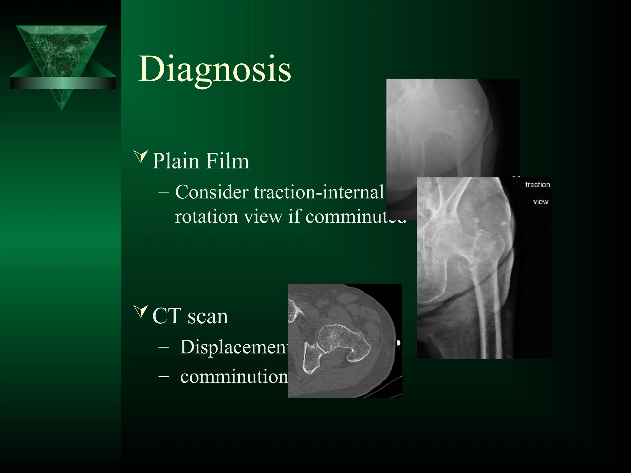 Plain Film
– Consider traction-internal
rotation view if comminuted
CT scan
– Displacement
– comminution
Diagnosis
 