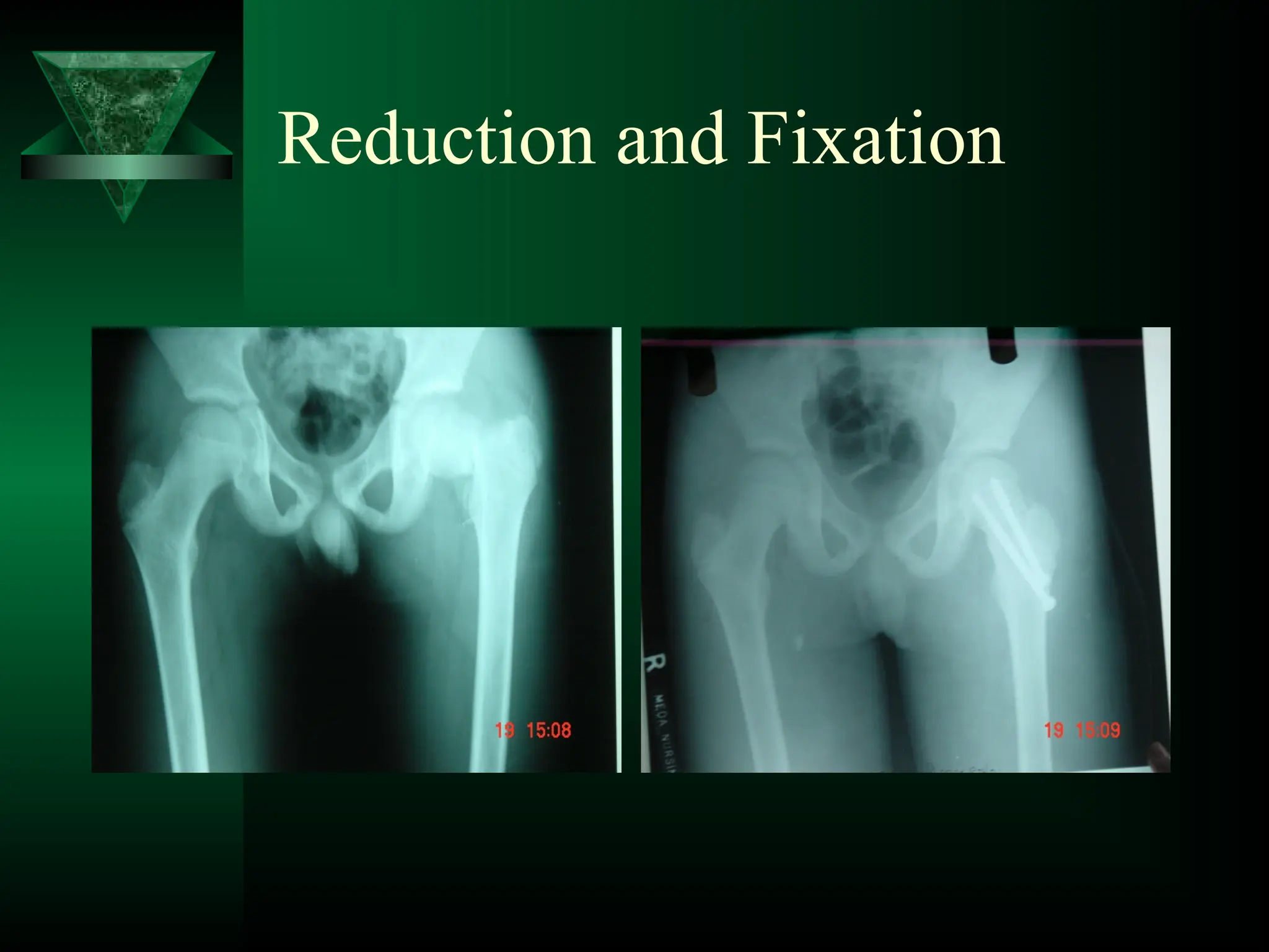 Reduction and Fixation
 