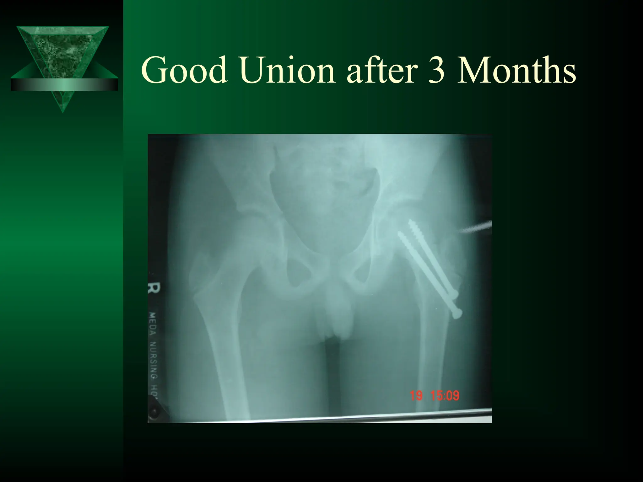 Good Union after 3 Months
 