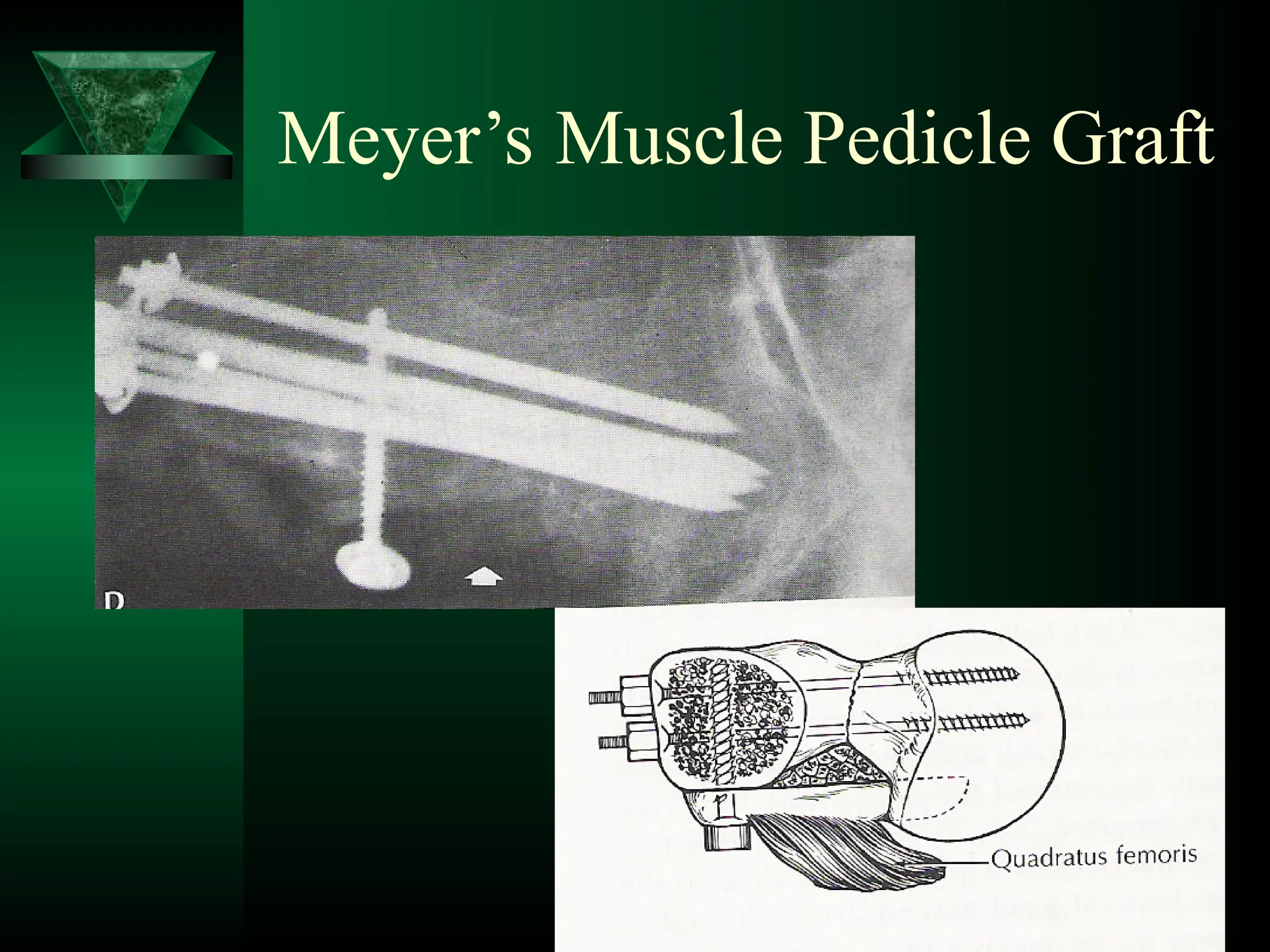Meyer’s Muscle Pedicle Graft
 