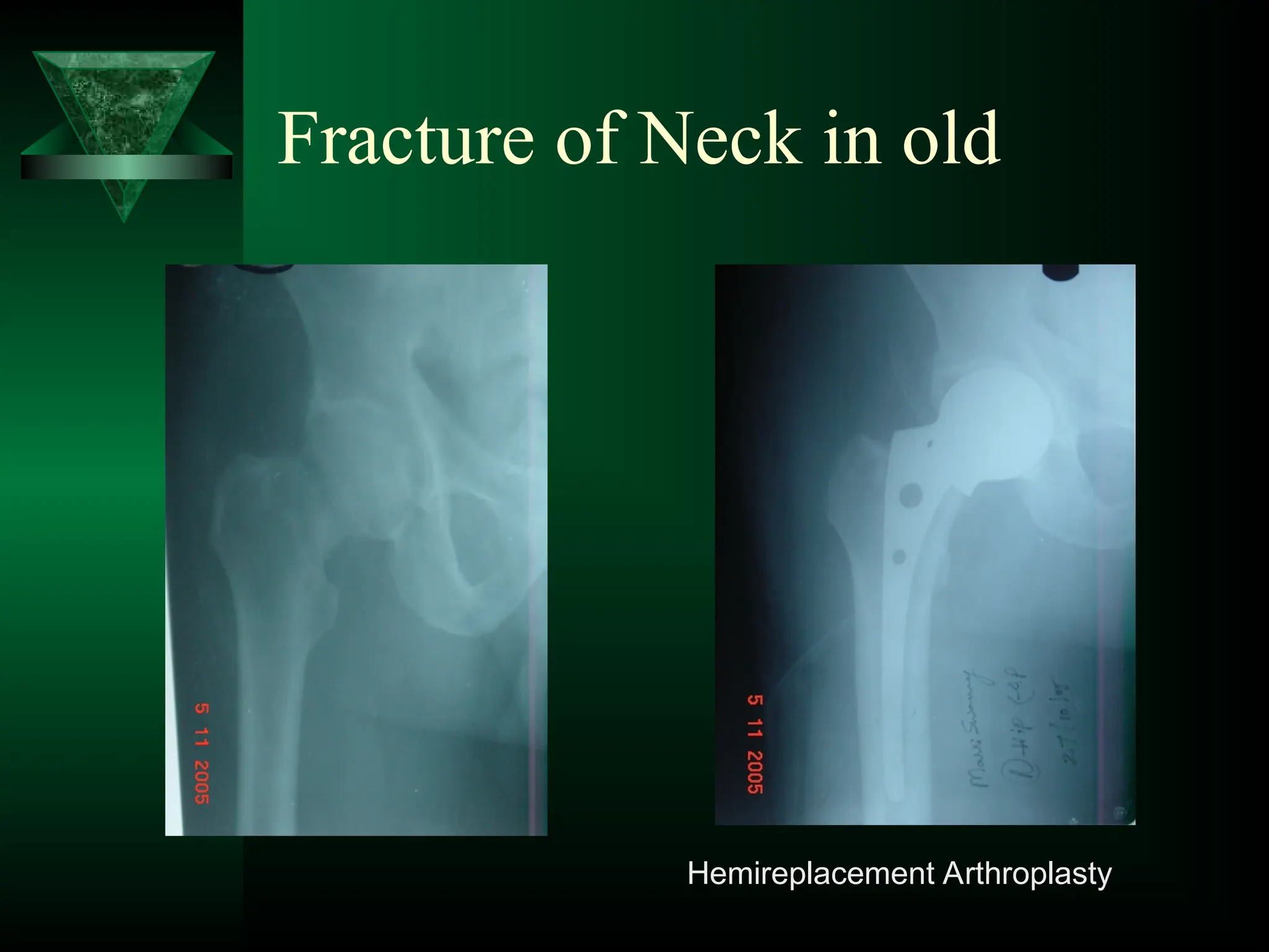 Fracture of Neck in old
Hemireplacement Arthroplasty
 