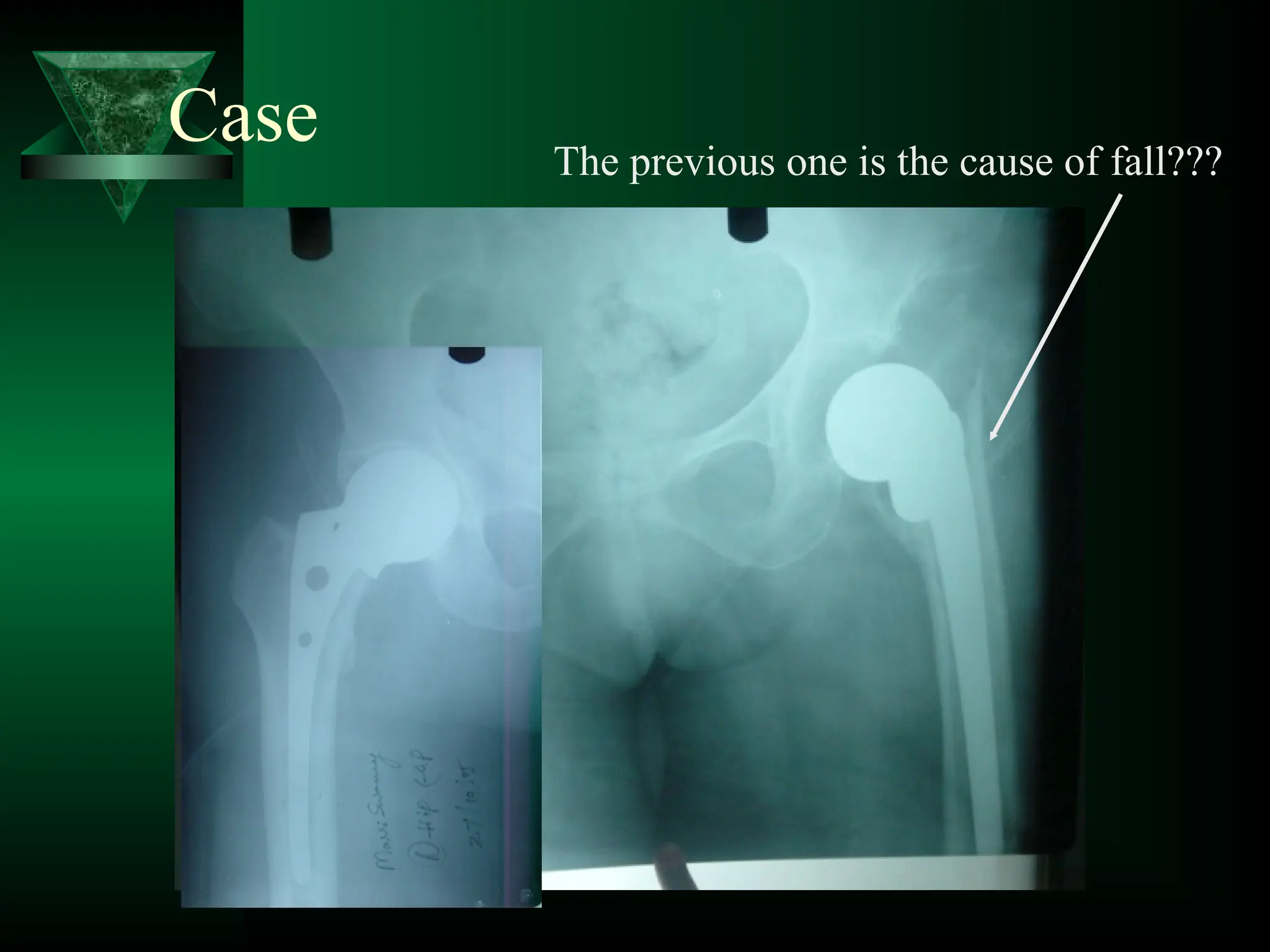 Case The previous one is the cause of fall???
 