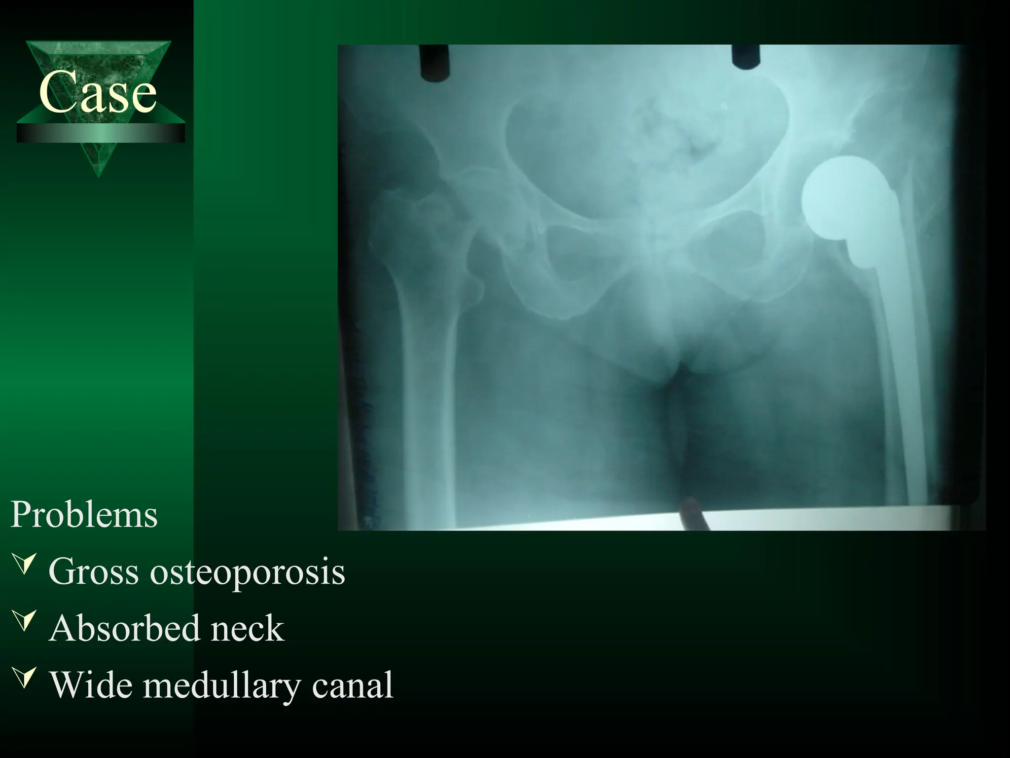 Case
Problems
 Gross osteoporosis
 Absorbed neck
 Wide medullary canal
 