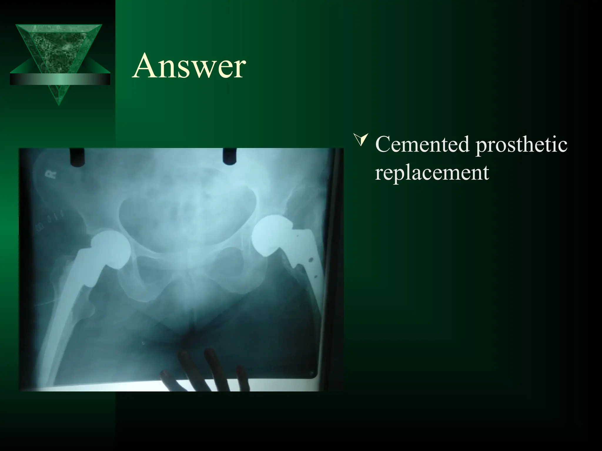 Answer
 Cemented prosthetic
replacement
 