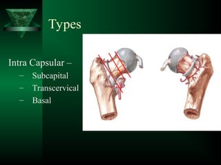 Intracapsular INTRACAPSULAR FRACTURE NECK OF FEMUR.ppt