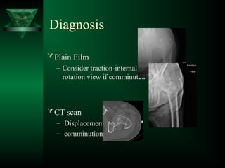 Traction Internal Rotation View INTRACAPSULAR FRACTURE NECK OF FEMUR.ppt