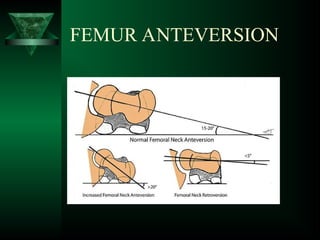 INTRACAPSULAR FRACTURE NECK OF FEMUR.ppt
