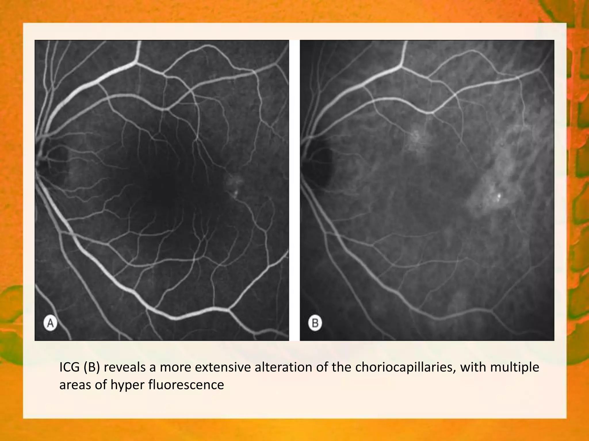 INDOCYANINE GREEN ANGIOGRAPHY | PPTX
