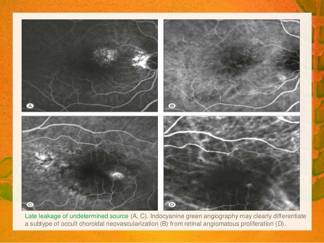 INDOCYANINE GREEN ANGIOGRAPHY