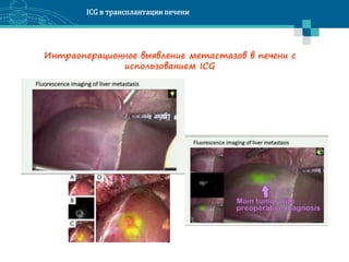 ICG in liver transplantation