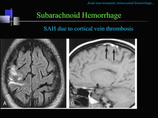 Acute non-traumatic intracranial hemorrhage…
Subarachnoid Hemorrhage
Perimesencephalic nonaneurysmal
subarachnoid hemorrha...