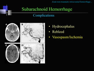 Acute non-traumatic intracranial hemorrhage…
Intraparenchymal Hemorrhage
Diagnosis
• CT
• MRI
• acute
• Subacute
• chronic
 