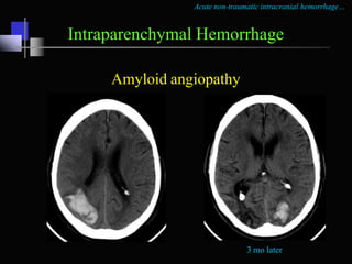 Acute non-traumatic intracranial hemorrhage…
Dural Sinus Thrombosis
10 yr boy
Dehydrated
Seizures
 