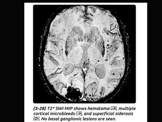 Acute non-traumatic intracranial hemorrhage…
Intraparenchymal Hemorrhage
Neoplasms
• Metastases – melanoma, renal, lung, b...