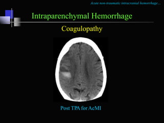 Acute non-traumatic intracranial hemorrhage…
Imaging guidelines
• NCCT – imaging of choice for suspected ICH
• Surgical ca...