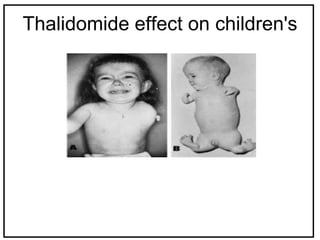 Thalidomide effect on children's
 