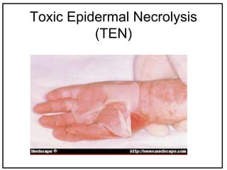 Toxic Epidermal Necrolysis
(TEN)
 