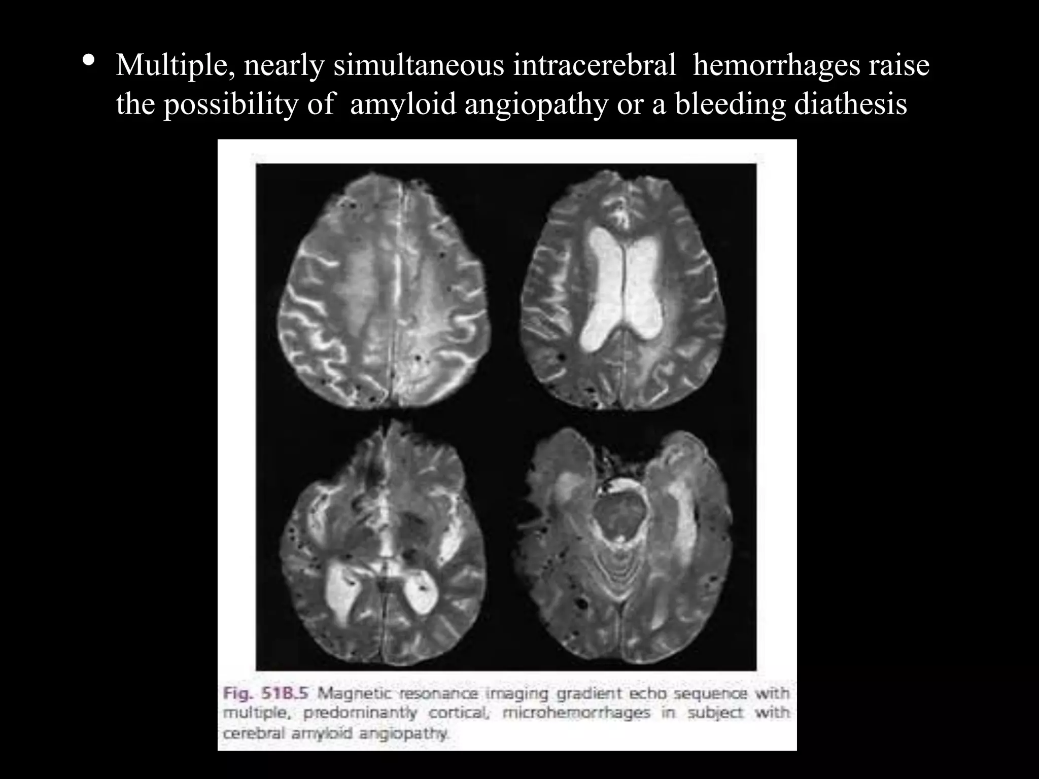 acute intracerebral haemorrhage: diagnosis and... Intracerebral hemorhage Diagnosis and management | PPTX