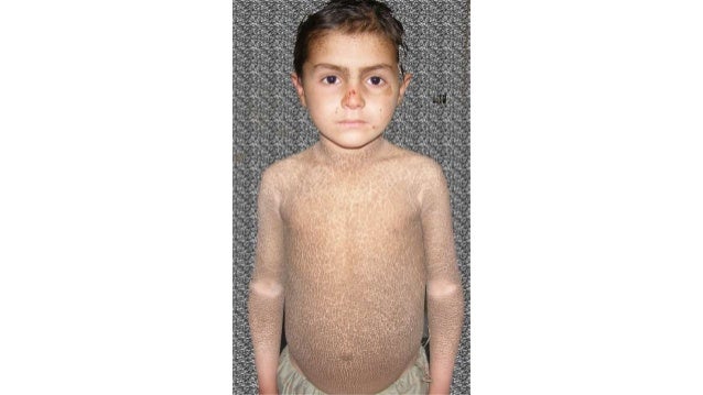 x linked ichthyosis