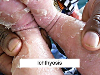Ichthyosis
 