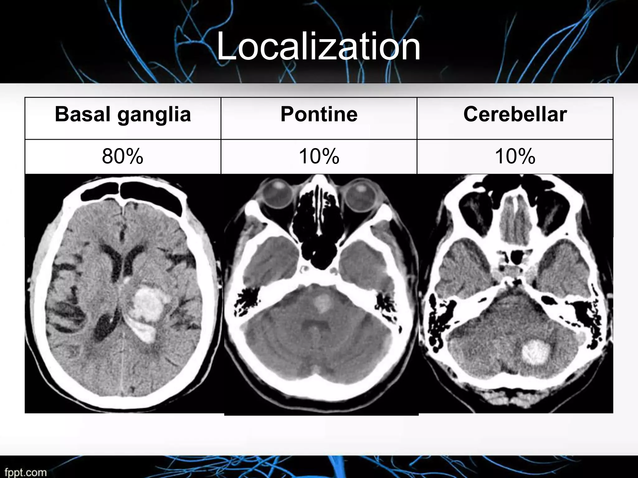 Intracerebral Hemorrhage Case presentation | PPTX