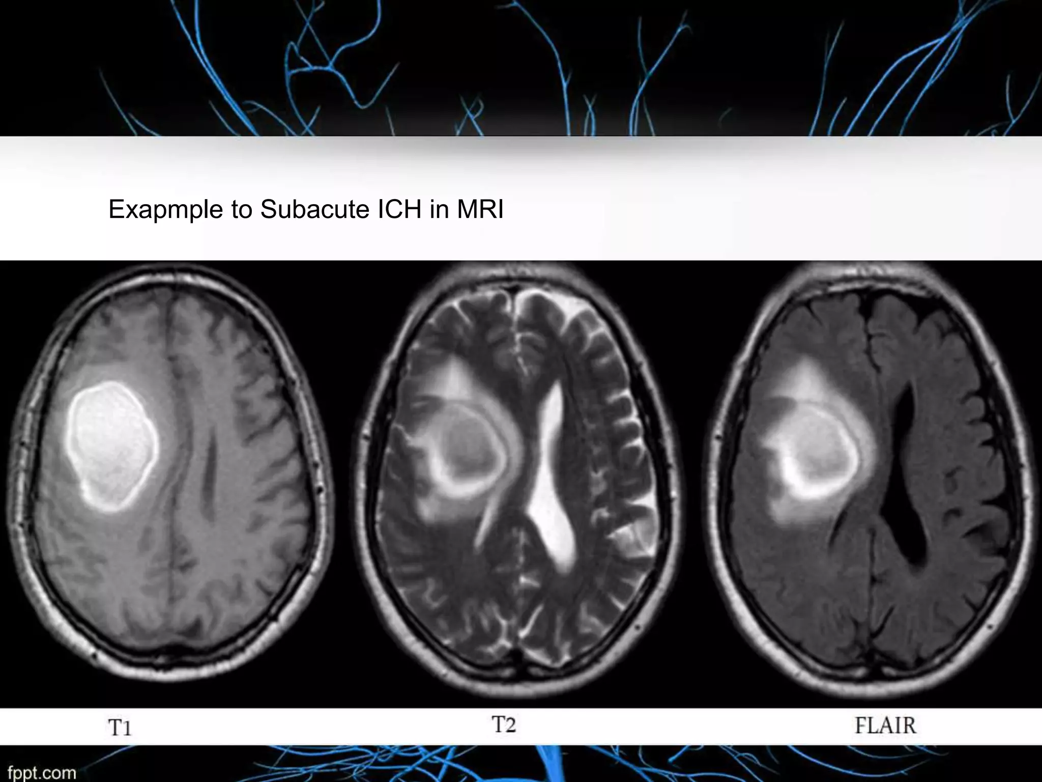 Intracerebral Hemorrhage Case presentation | PPTX